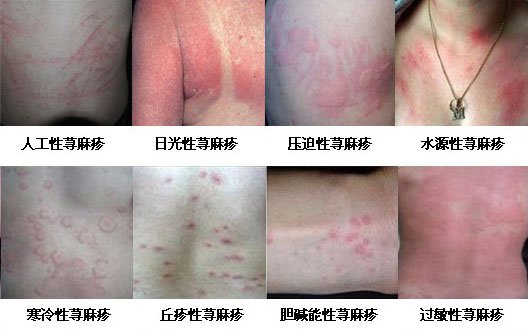 荨麻疹的临床诊断依据