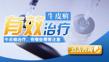 成都牛皮癣最好治疗方法