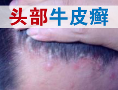 头部银屑病患者需要注意什么